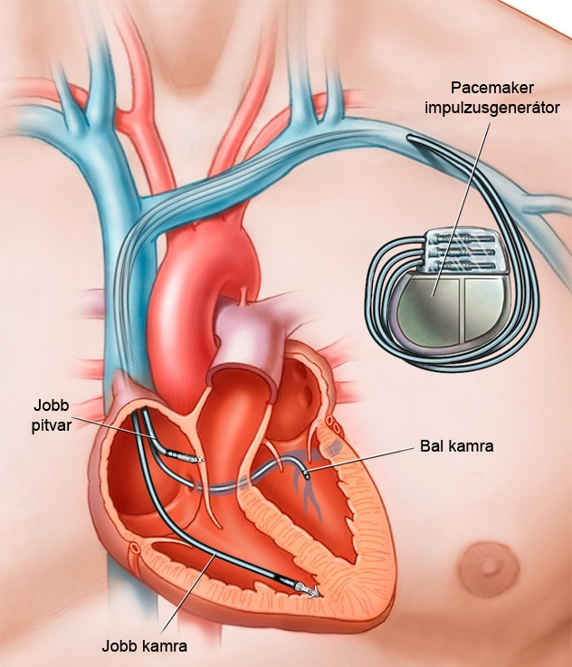 pacemaker grafika